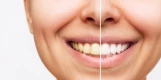 Gelbe vs. Weiße Zähne